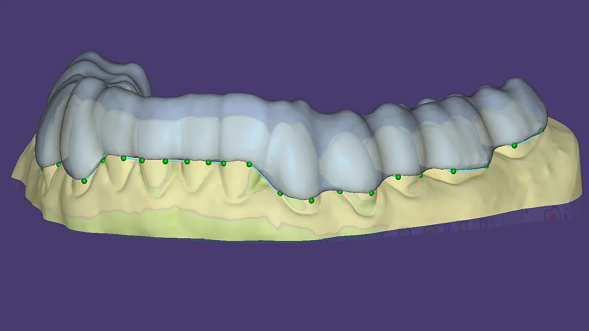 AI-supported bite splint design in DentalCAD
