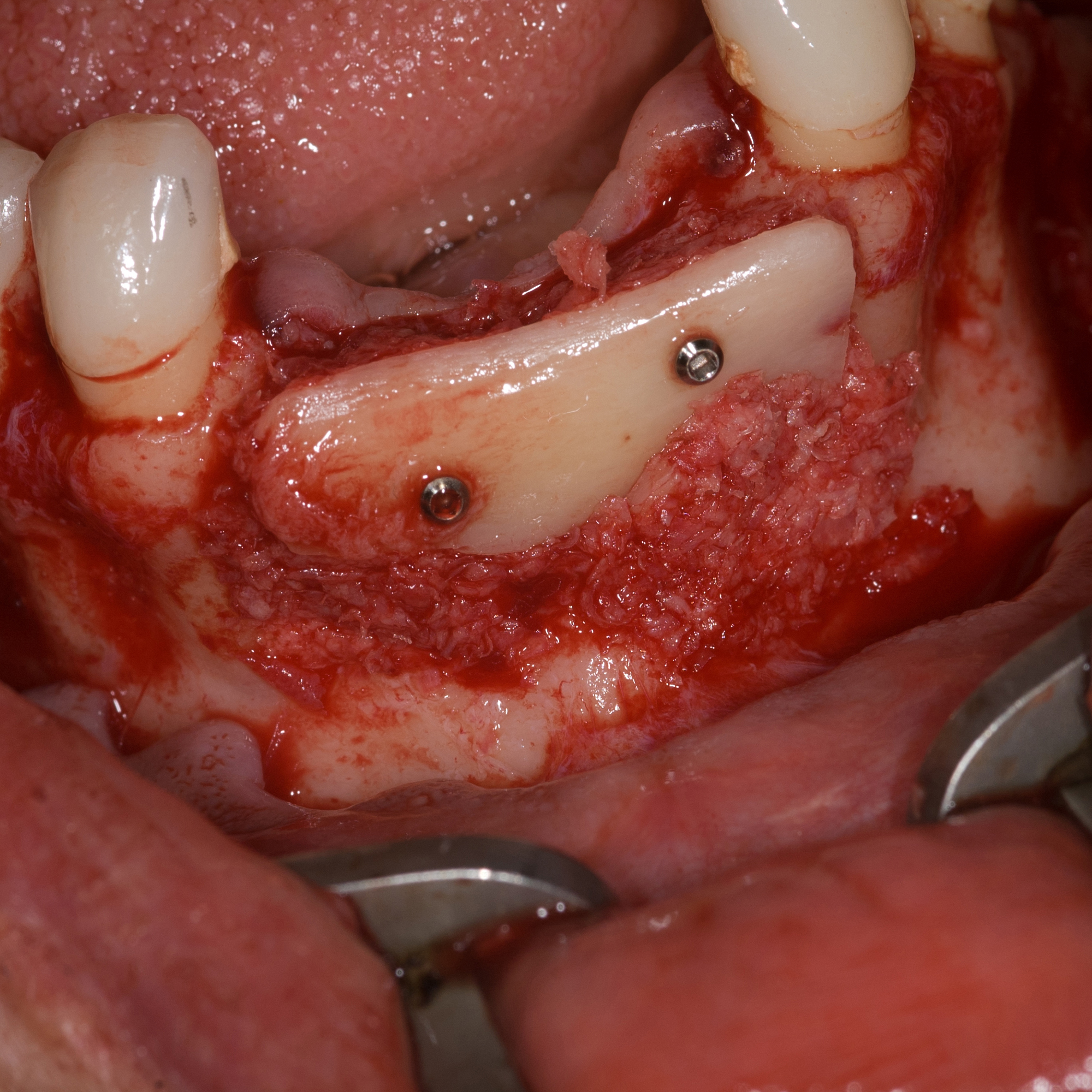 Greftless Implantology