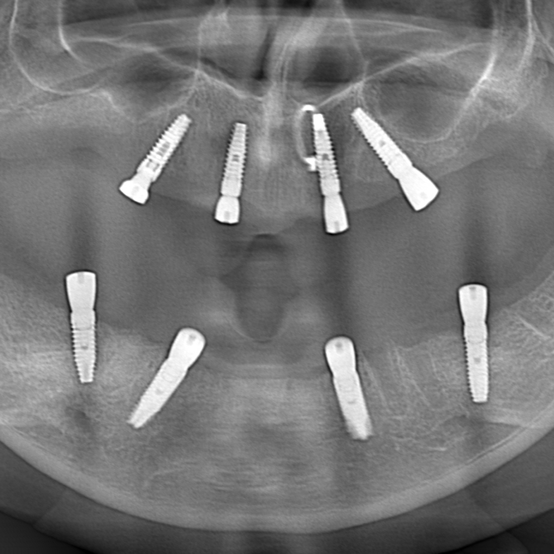 Paradigm Shift in Hybrid Prosthesis