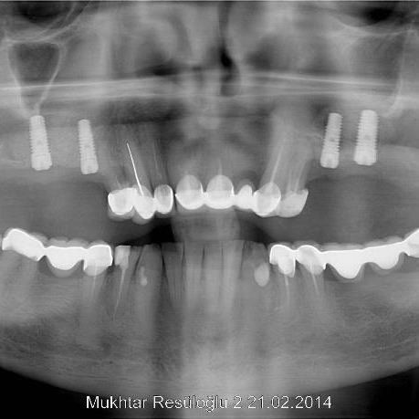 98% Success of Mode Implant System