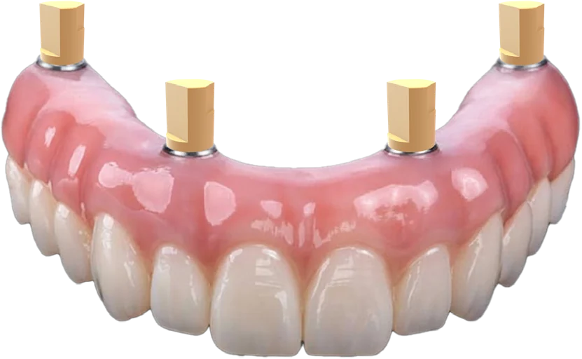 Temporary full-arch prosthesis with Reverse Scanbodies attached