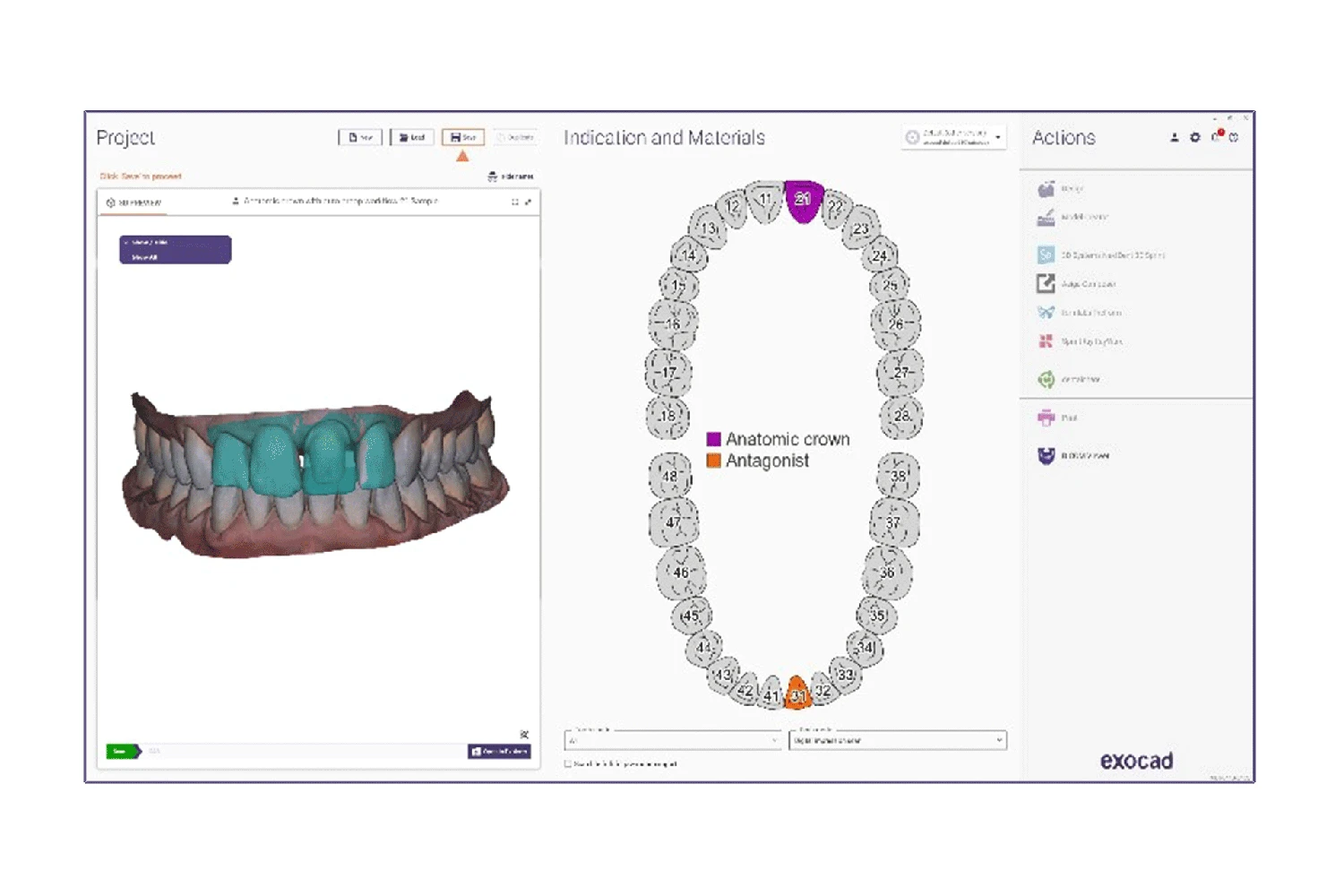 ChairsideCAD project workspace showing a digital scan, tooth selection and restorative indications