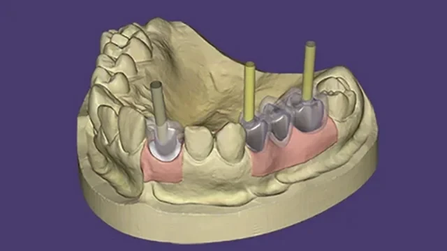 DentalCAD Implant Module visualization of implant-supported restorations