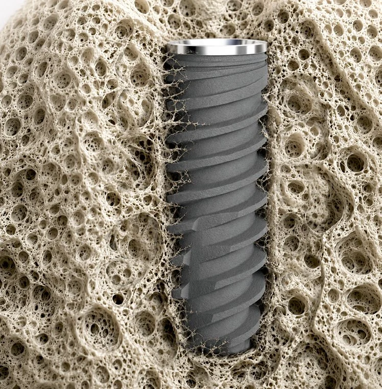 Implant surrounded by bone tissue