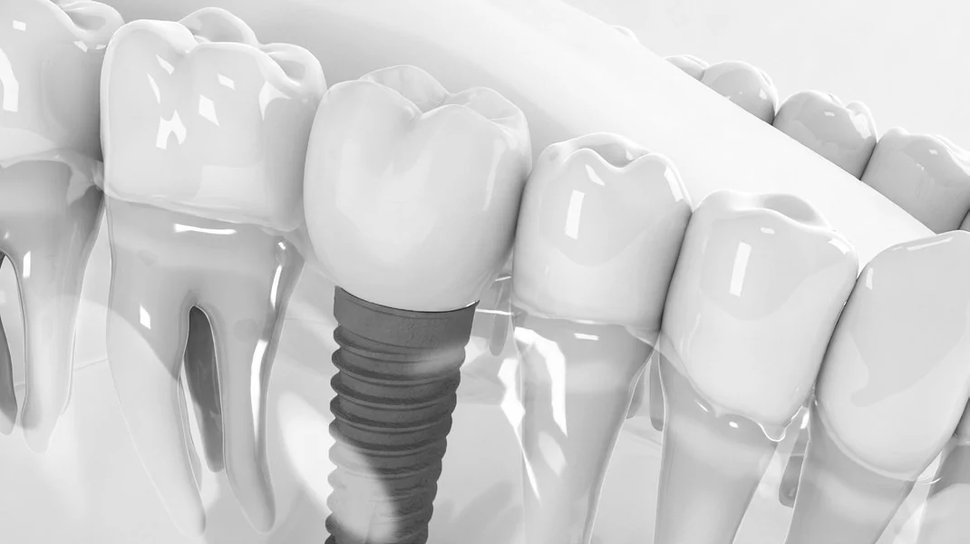 Dental implant in the jaw between natural teeth